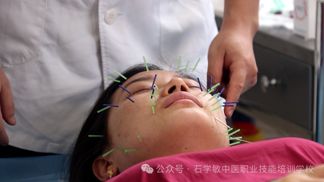 明星都在做的针灸美容,到底靠不靠谱?